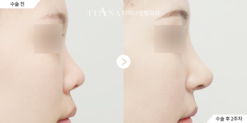 隆鼻術前準備：手術前兩週到當天的 5 個重點 — 隆鼻術前準備 TIANA 整形外科