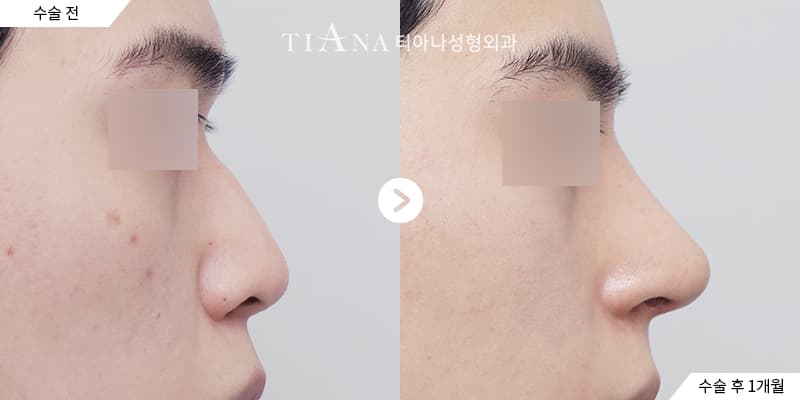 隆鼻後多久可以做其他療程？玻尿酸、霧眉與眼睛手術 — 隆鼻後多久可以做其他療程 TIANA 整形外科