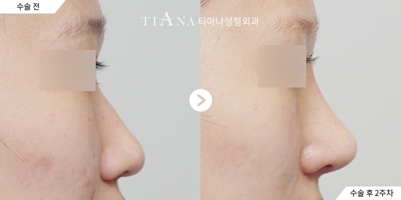 韓國整形退稅 2026 年起不適用：報價要看的 4 件事 — 韓國整形退稅 TIANA 整形外科
