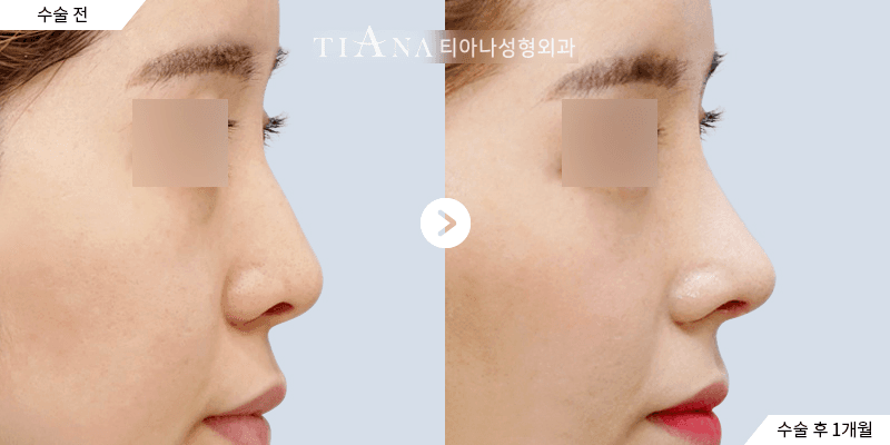 側臉線條與鼻頭比例,自然修飾 — TIANA 韓國隆鼻 術前術後
