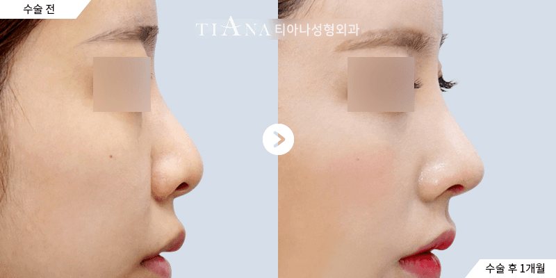 Rhinoplasty photo consultation: which 5 photos — rhinoplasty photo consultation at TIANA