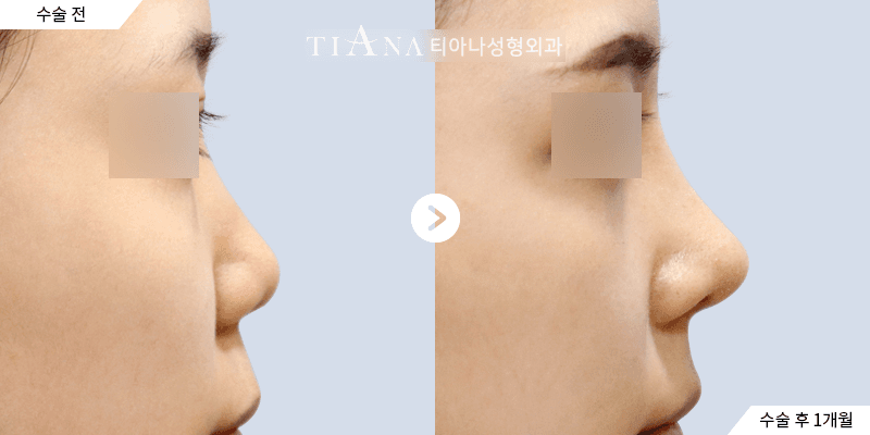 Profile line and tip balance, refined naturally — rhinoplasty in Korea before and after at TIANA