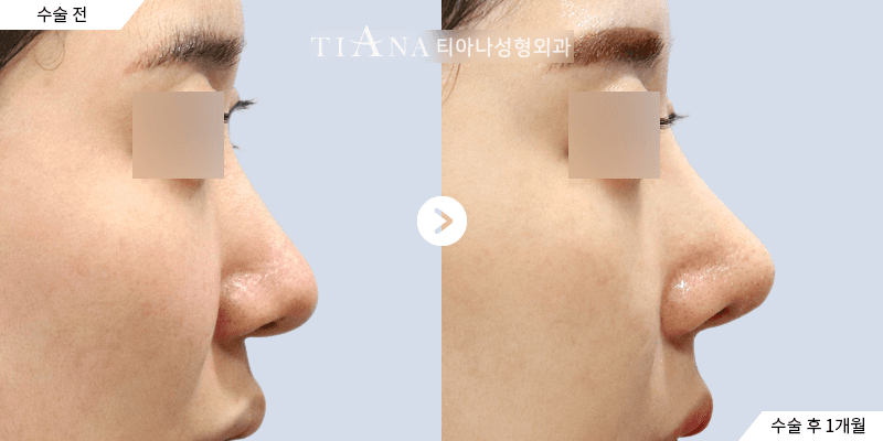 側臉線條與鼻頭比例,自然修飾 — TIANA 韓國隆鼻 術前術後