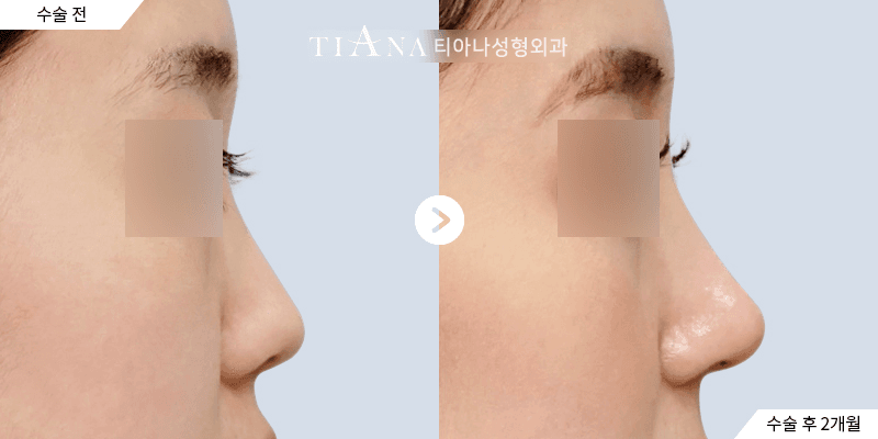 側臉線條與鼻頭比例,自然修飾 — TIANA 韓國隆鼻 術前術後