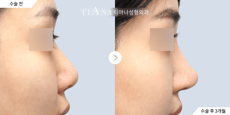 Bulbous nose rhinoplasty in Korea before and after, side profile at TIANA