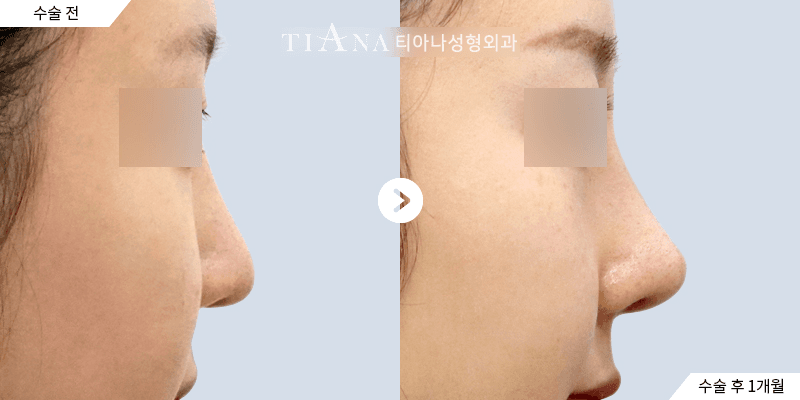 Profile line and tip balance, refined naturally — rhinoplasty in Korea before and after at TIANA