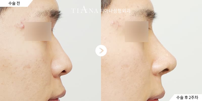 側臉線條與鼻頭比例,自然修飾 — TIANA 韓國隆鼻 術前術後