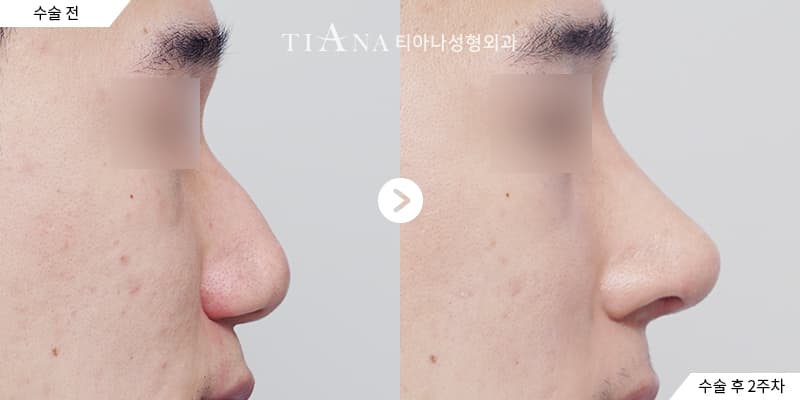 側臉線條與鼻頭比例,自然修飾 — TIANA 韓國隆鼻 術前術後