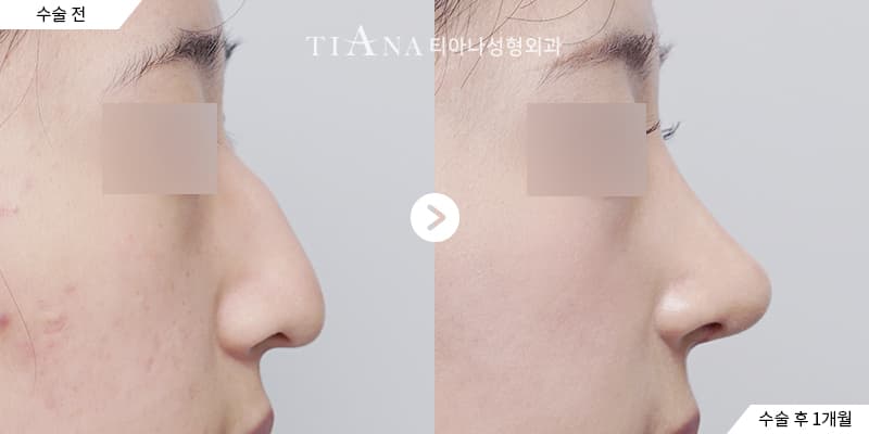 肋軟骨隆鼻是什麼?什麼情況需要用到肋軟骨 — 肋軟骨隆鼻 TIANA 整形外科