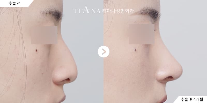 Profile line and tip balance, refined naturally — rhinoplasty in Korea before and after at TIANA
