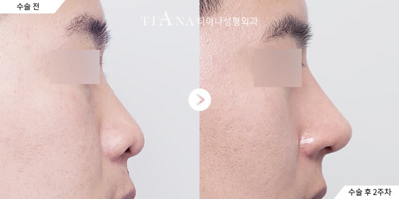 首爾隆鼻要待幾天?7~14 晚行程安排 — 首爾隆鼻 TIANA 整形外科