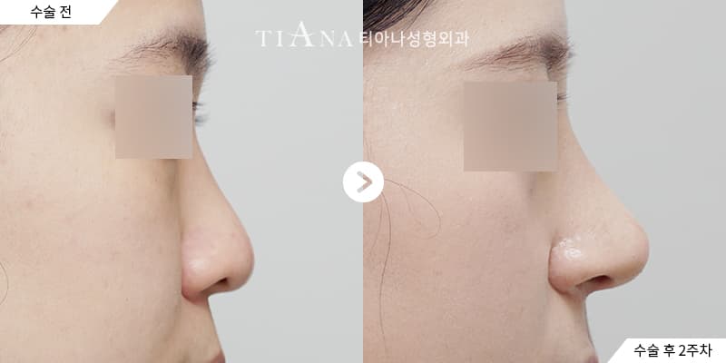 側臉線條與鼻頭比例,自然修飾 — TIANA 韓國隆鼻 術前術後
