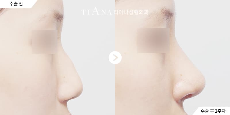 Profile line and tip balance, refined naturally — rhinoplasty in Korea before and after at TIANA