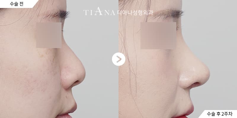 Higher bridge and defined tip, still natural — rhinoplasty in Korea before and after at TIANA