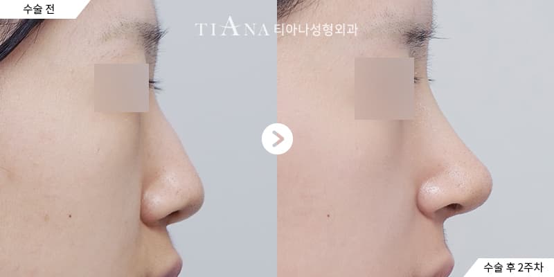 Higher bridge and defined tip, still natural — rhinoplasty in Korea before and after at TIANA