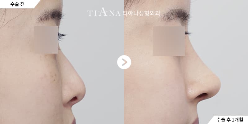 鼻樑更挺、鼻頭更俐落,看起來依然自然 — TIANA 韓國隆鼻 術前術後