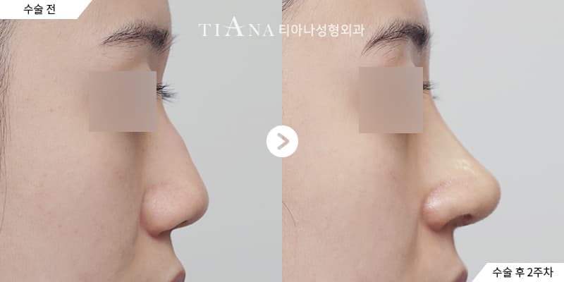 Higher bridge and defined tip, still natural — rhinoplasty in Korea before and after at TIANA