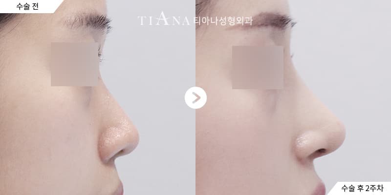 Higher bridge and defined tip, still natural — rhinoplasty in Korea before and after at TIANA