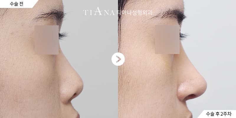 鼻樑更挺、鼻頭更俐落,看起來依然自然 — TIANA 韓國隆鼻 術前術後