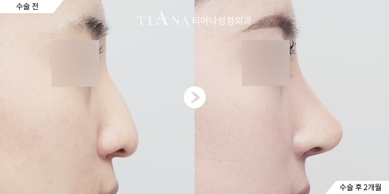 Higher bridge and defined tip, still natural — rhinoplasty in Korea before and after at TIANA