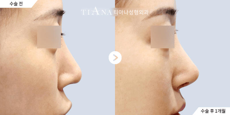 Revision rhinoplasty — corrected profile — rhinoplasty in Korea before and after at TIANA
