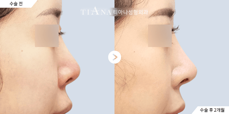 Revision rhinoplasty Korea before and after at TIANA, corrected side profile