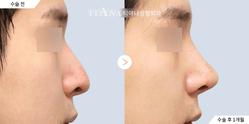 Revision rhinoplasty — corrected profile — rhinoplasty in Korea before and after at TIANA