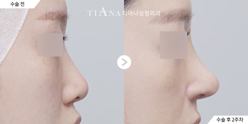 隆鼻修復 — 側臉線條重新調整 — TIANA 韓國隆鼻 術前術後