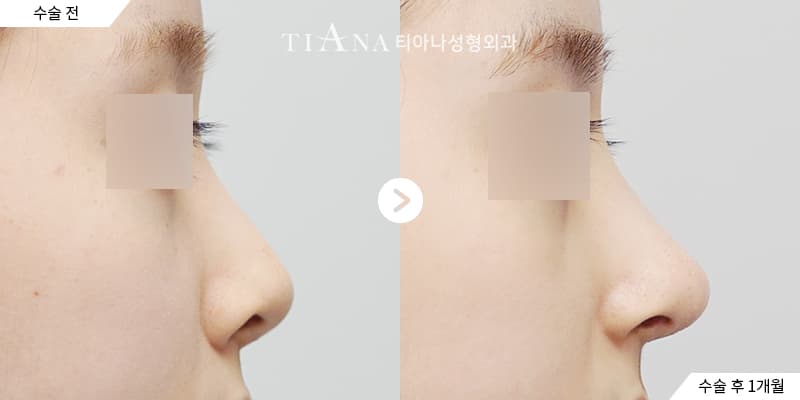隆鼻修復 — 側臉線條重新調整 — TIANA 韓國隆鼻 術前術後