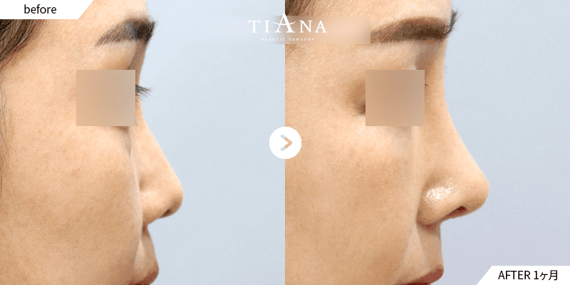 鼻筋を高くして立体感のある横顔に|術後1ヶ月 韓国 鼻整形 ビフォーアフター ティアナ