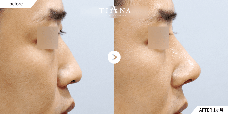 鼻 拘縮とは?鼻先が上がる・硬くなる原因と再手術の判断基準|鼻 拘縮 ティアナ整形外科