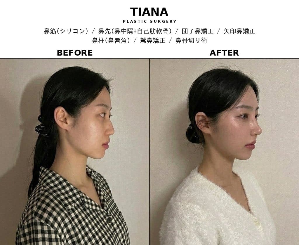 ティアナ鼻整形 施術メニュー 鼻筋・鼻先・団子鼻矯正・鷲鼻・骨切り