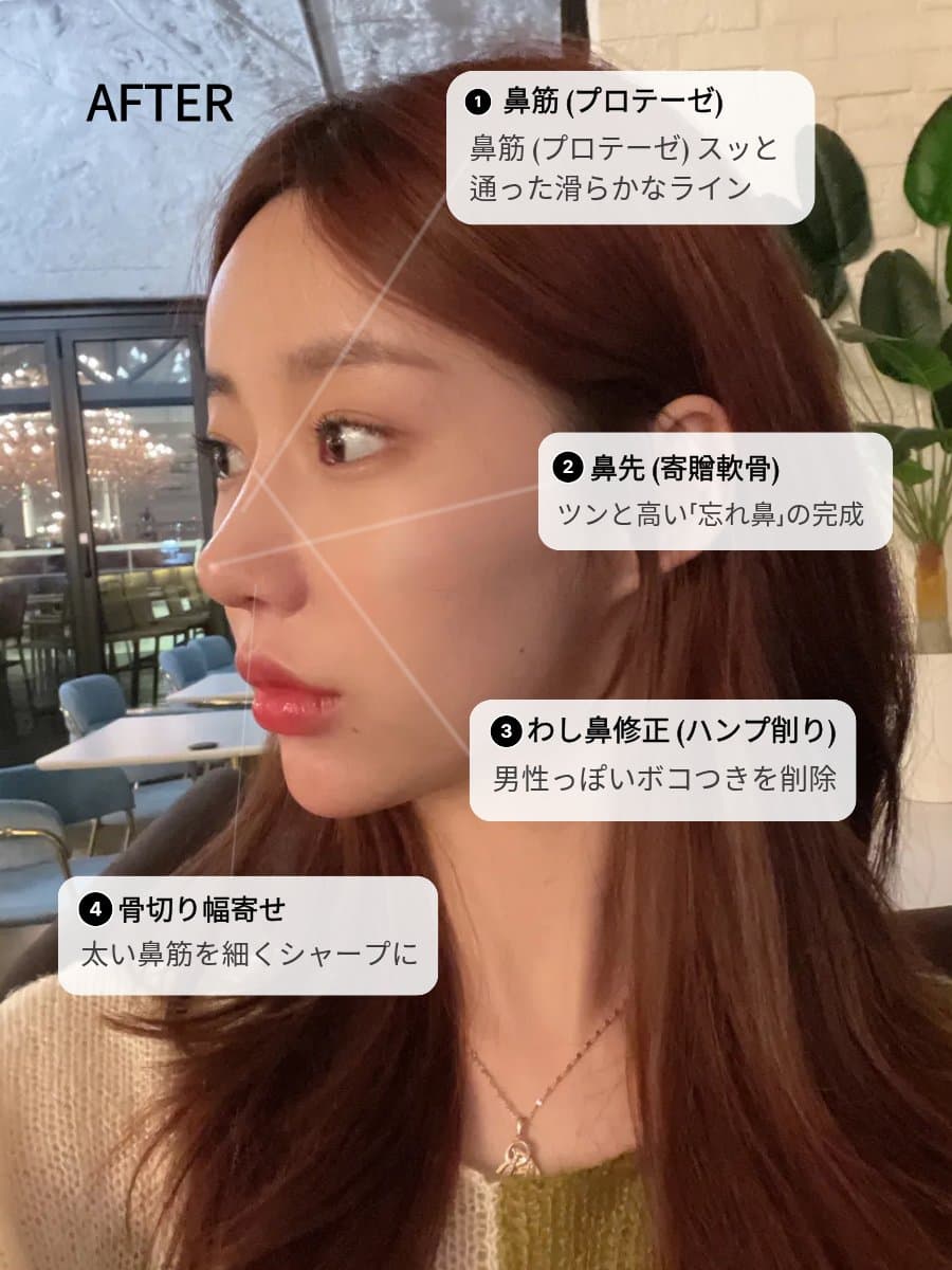 忘れ鼻とは?整形でつくれる自然な横顔デザインの考え方|忘れ鼻 ティアナ整形外科