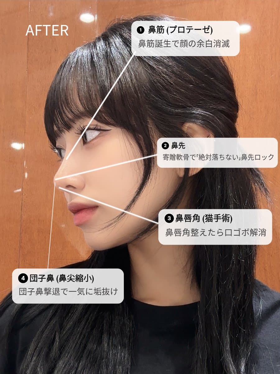 韓国 鼻整形 ダウンタイム、いつまで続く?院長が正直に答えます|韓国 鼻整形 ダウンタイム ティアナ整形外科