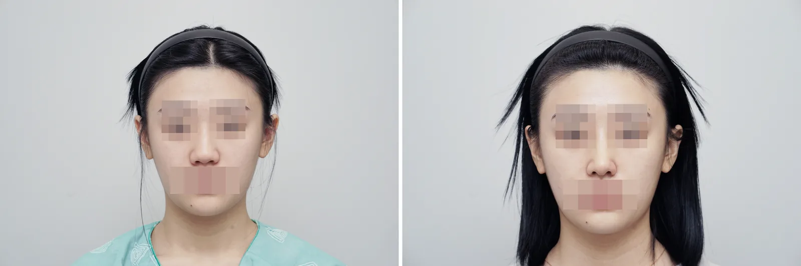 Rhinoplasty example case, hump nose, bulbous tip, front view before and after
