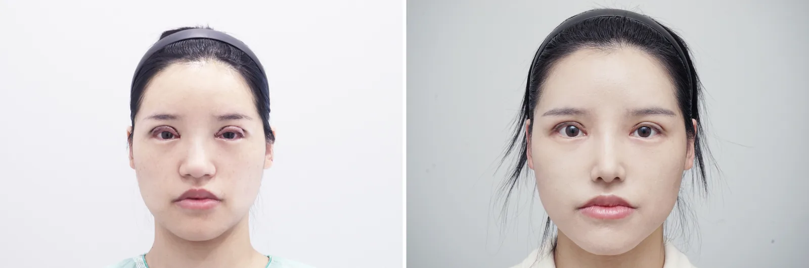 Rhinoplasty example case, bulbous tip, long nose, front view before and after