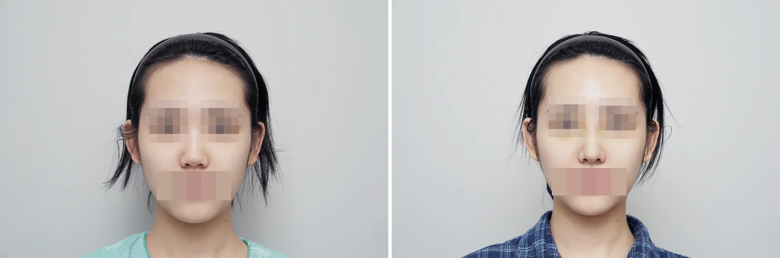 鼻整形の症例写真(短鼻・正面の術前術後)
