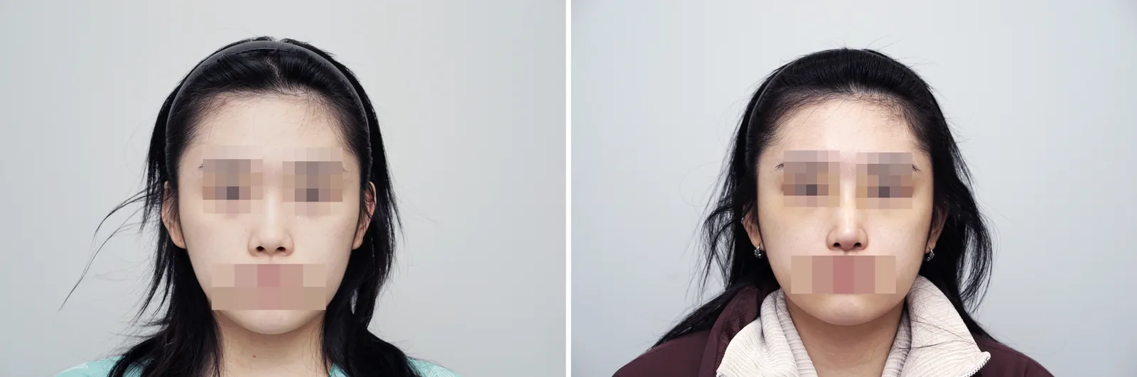 Rhinoplasty example case, hump nose, bulbous tip, front view before and after