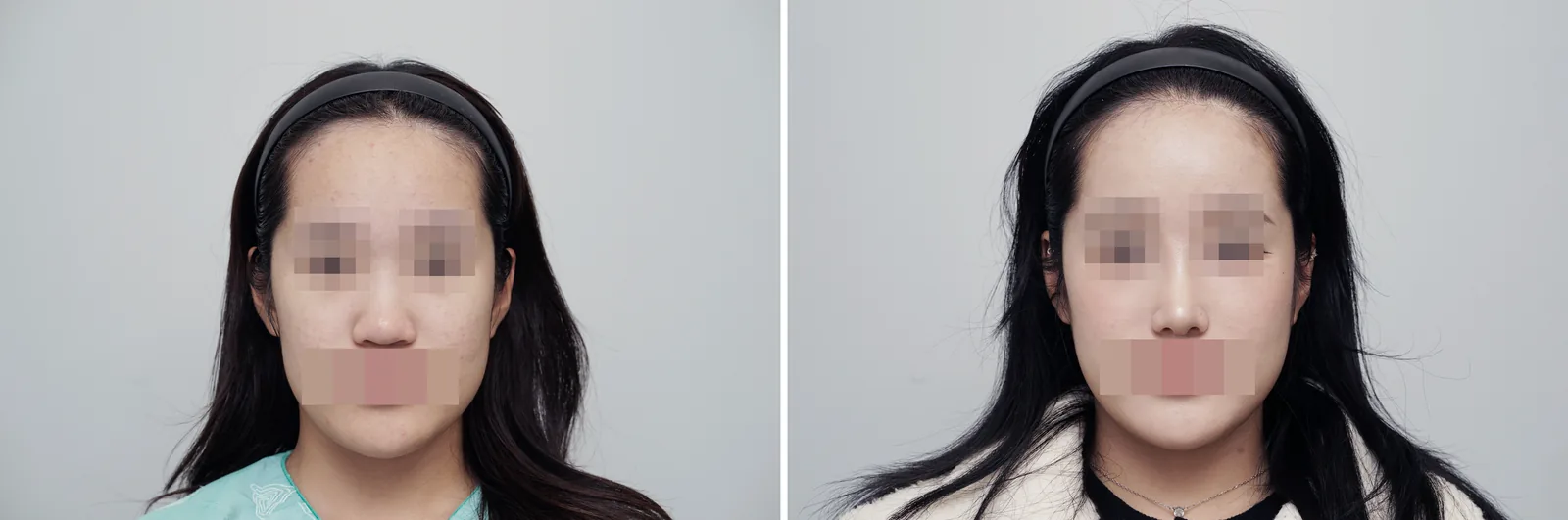 Rhinoplasty example case, bulbous tip, front view before and after