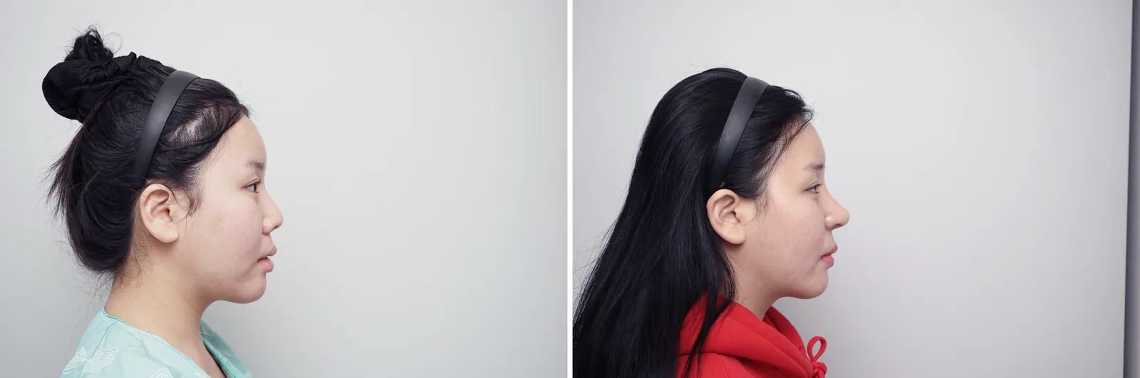 Rhinoplasty example case, revision rhinoplasty, side view before and after