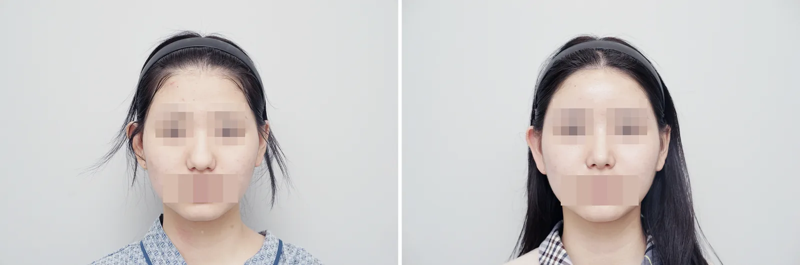 Rhinoplasty example case, hump nose, bulbous tip, front view before and after