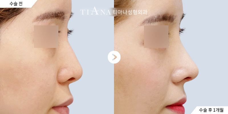 TIANA case, side profile before and 1 month after rhinoplasty