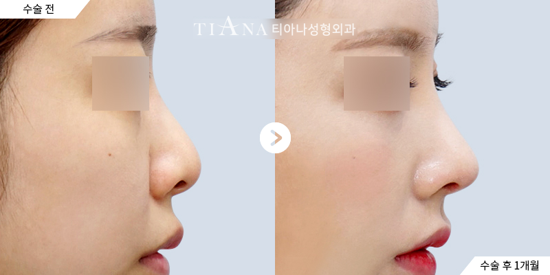 TIANA rhinoplasty case, side profile of the bridge and tip