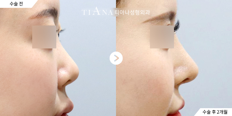 Side profile before and two months after rhinoplasty