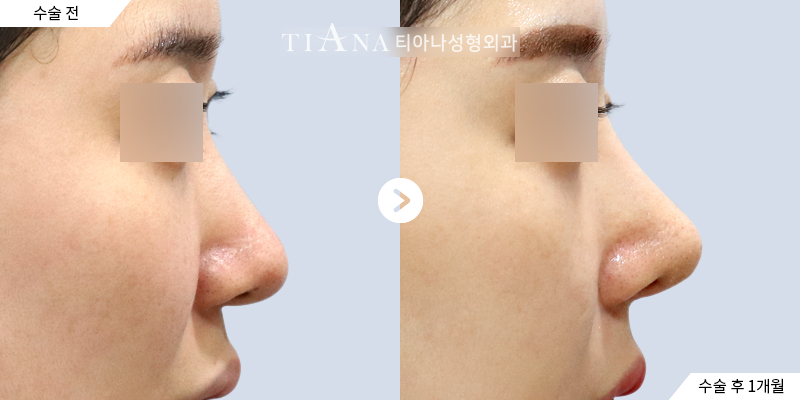 TIANA rhinoplasty case, bridge and tip shaped together