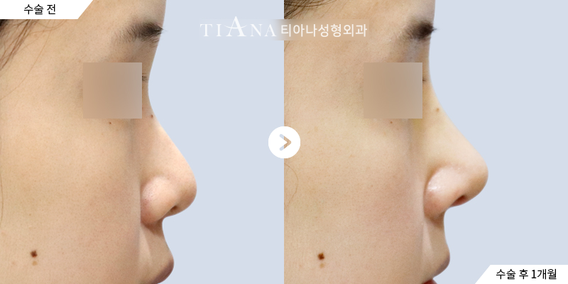 TIANA 鼻整形術前術後案例，鼻翼與鼻頭的正側面比例變化