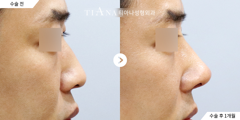 TIANA 隆鼻術前術後的側臉對照案例,鼻頭與鼻樑線條更自然