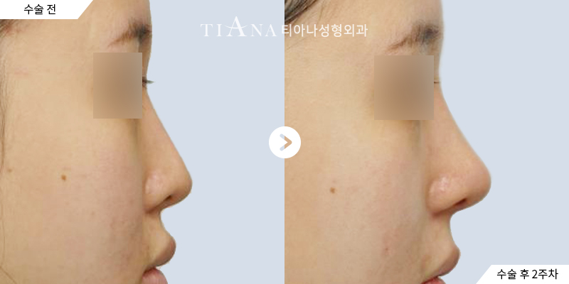 TIANA 隆鼻術前術後案例,鼻樑墊高與鼻頭支撐的側臉比例