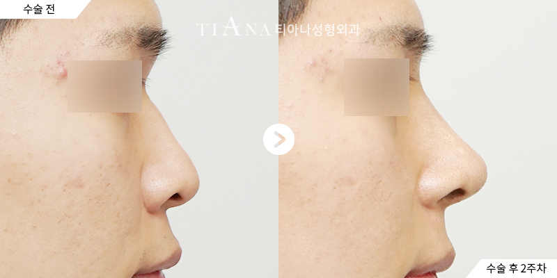TIANA 隆鼻術前術後案例,鼻頭更俐落且側臉線條自然
