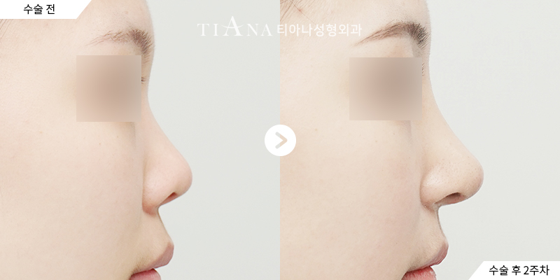 TIANA 隆鼻術前術後案例，鼻樑與鼻頭的側臉線條